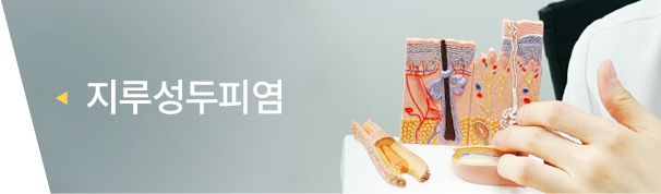 지루성두피염